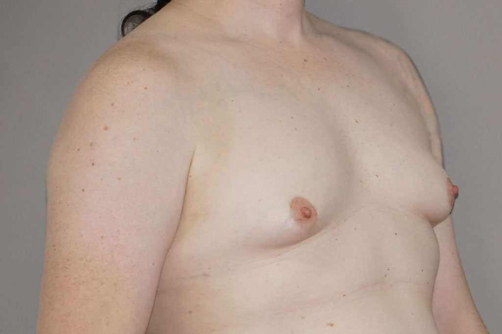 Mann zu Frau OP Zürich Brustvergrößerung Transgender-Patient 03